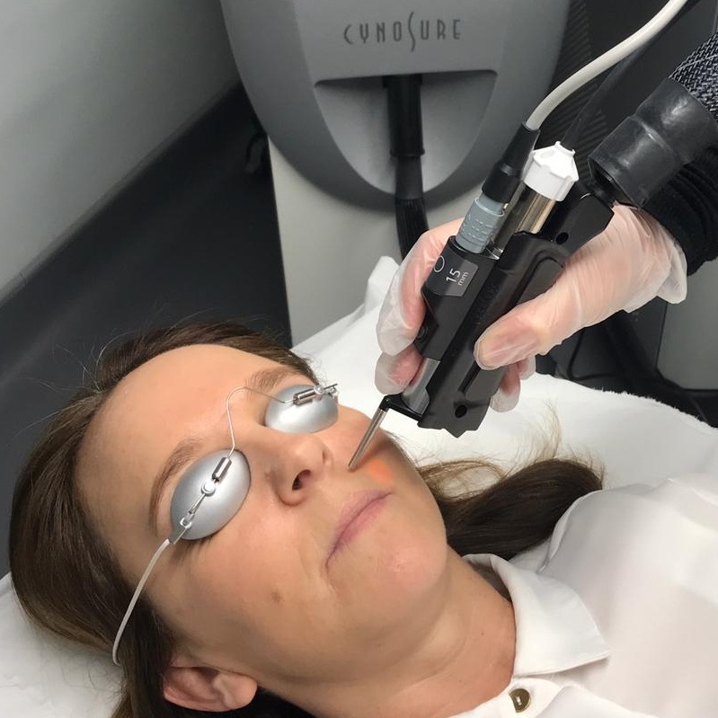 لیزر موهای زائد با دستگاه سایناشور لیزر موهای زائد با دستگاه سایناشور