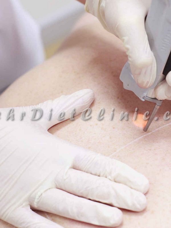 لیزر مو های زائد غرب تهران لیزر مو های زائد غرب تهران