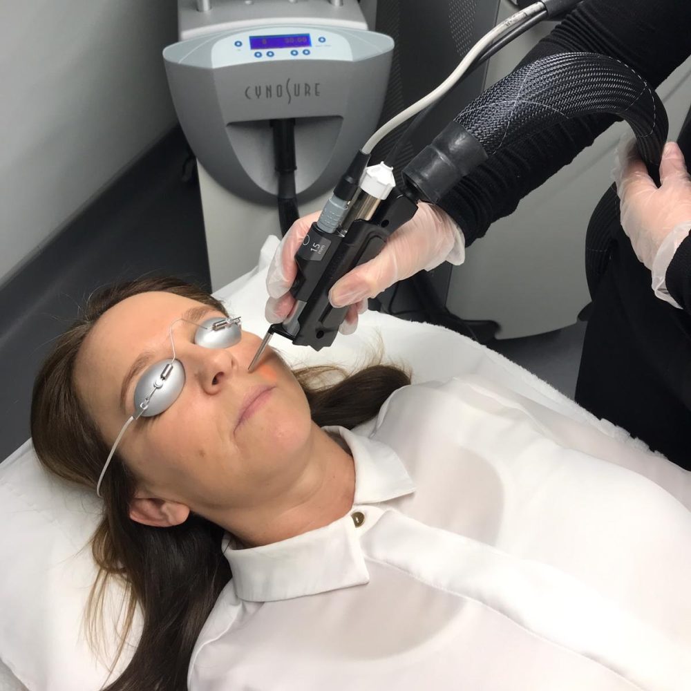 لیزر موی زائد با دستگاه سایناشور